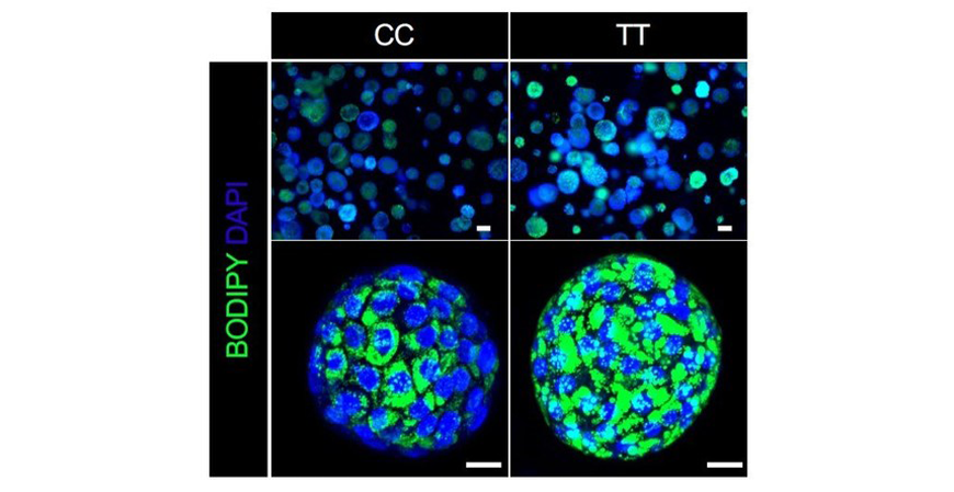 When type 2 diabetes and fatty liver disease occur together a single gene variant—GCKR-rs1260326 TT—can sharply accelerate fat accumulation as shown by the green-stained areas of the liver organoid shown in the lower right panel.