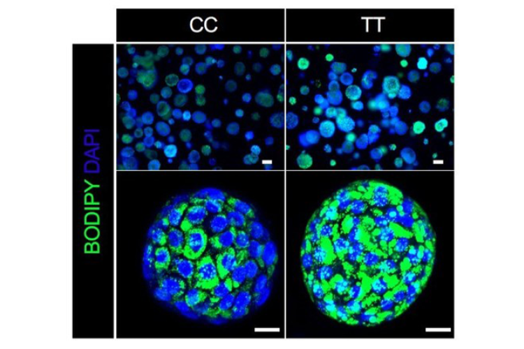 When type 2 diabetes and fatty liver disease occur together a single gene variant—GCKR-rs1260326 TT—can sharply accelerate fat accumulation as shown by the green-stained areas of the liver organoid shown in the lower right panel.